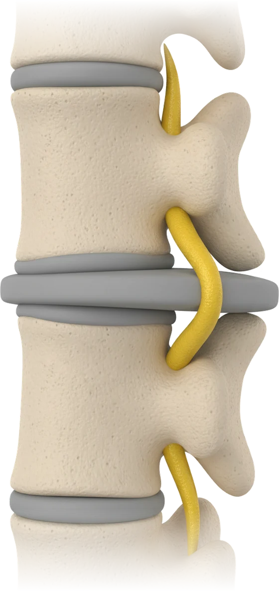 3D render of two lumbar vertebrae: the disc pressing outward and the yellow nerve root bending around it.